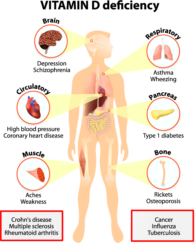 Symptoms Of Vitamin D Deficiency In Children Baby Health