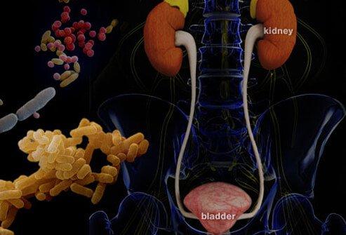 urinary tract infection