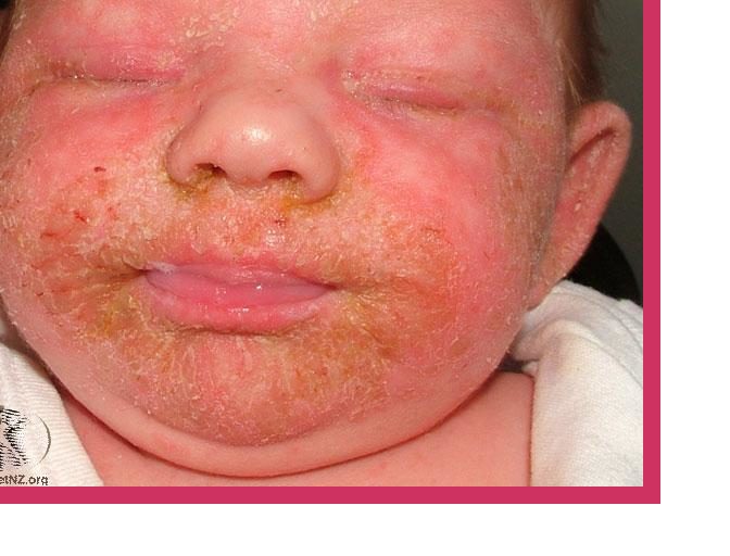 Treatment For Eczema In Infants