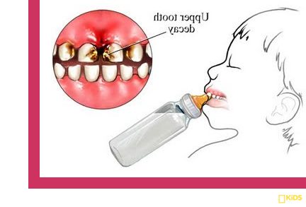tooth decay