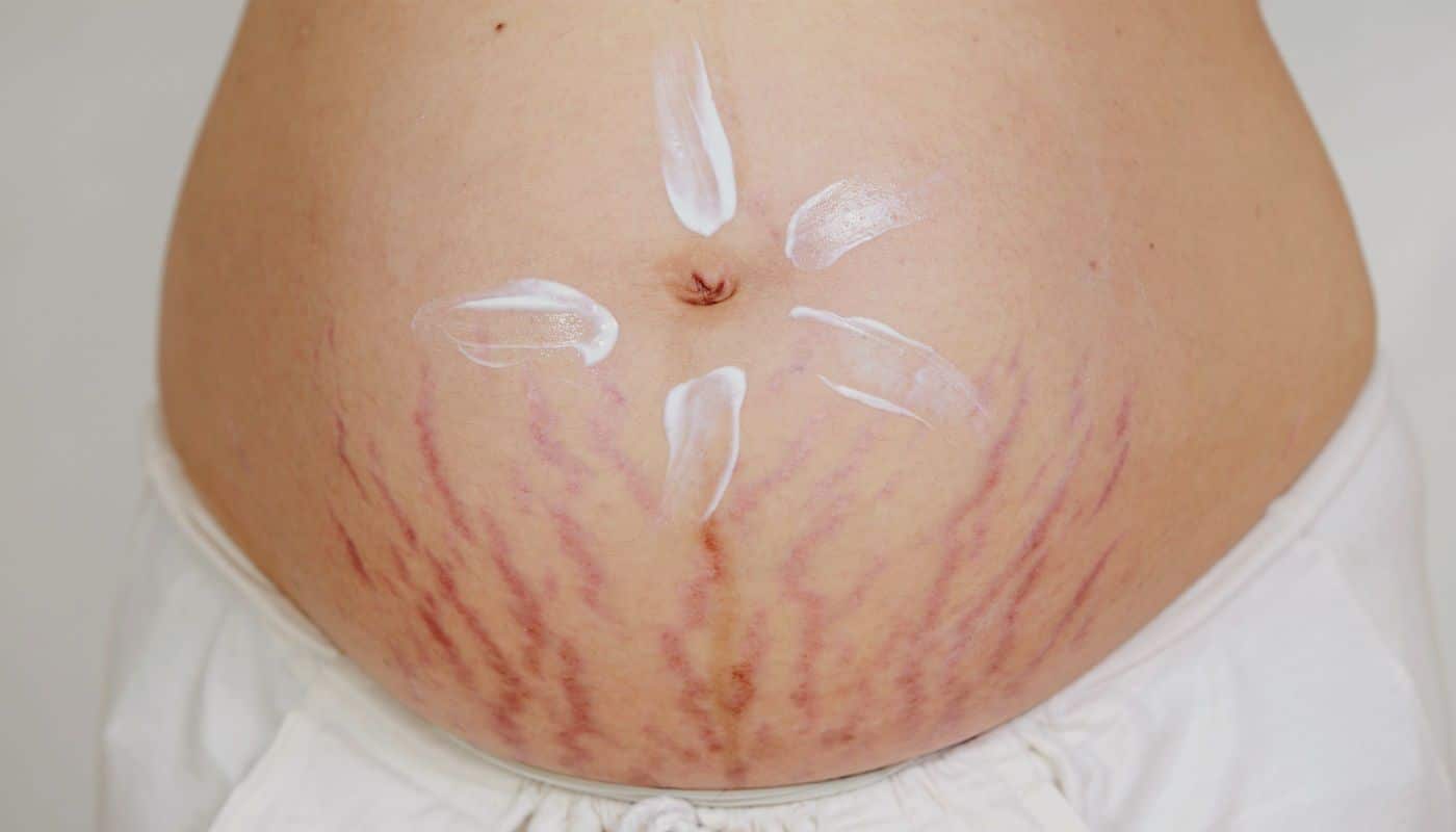 pregnancy stretch marks